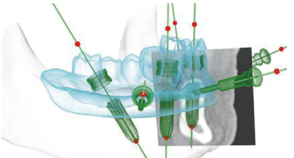 三维导板确定种植牙位置 三维导板确定种植牙位置