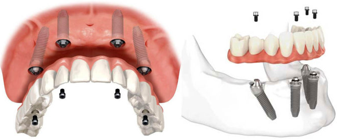 All-on-4全口种植牙 All-on-4全口种植牙