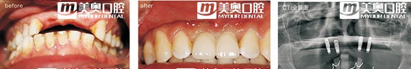 多颗种植牙修复案例 多颗种植牙修复案例