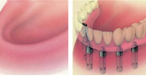 种植牙示意图 种植牙示意图