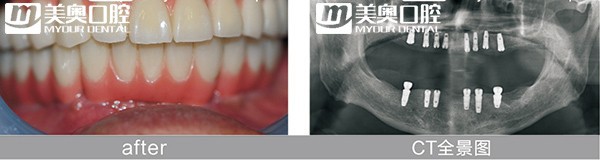 苏州美奥口腔种植牙案例 苏州美奥口腔种植牙案例