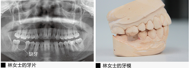 林女士的牙片和牙模-美奥口腔 林女士的牙片和牙模-美奥口腔